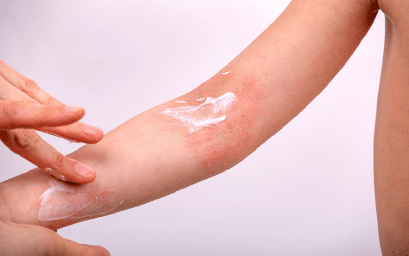 Hướng dẫn chăm sóc da cho người mắc bệnh chàm Nguyên nhân và biểu hiện của bệnh chàm